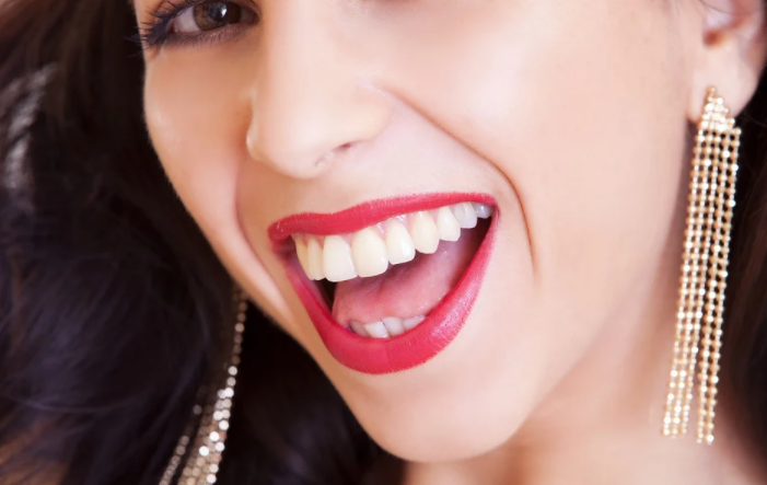 dental aligner